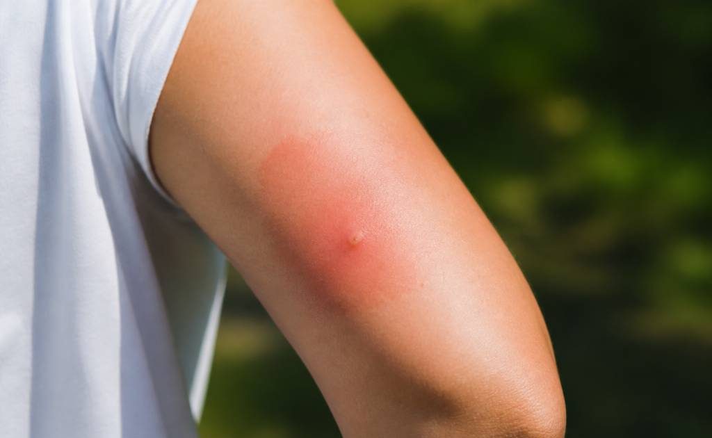 À quoi ressemble une piqûre d'abeille et quand consulter ?