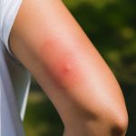 À quoi ressemble une piqûre d'abeille et quand consulter ?
