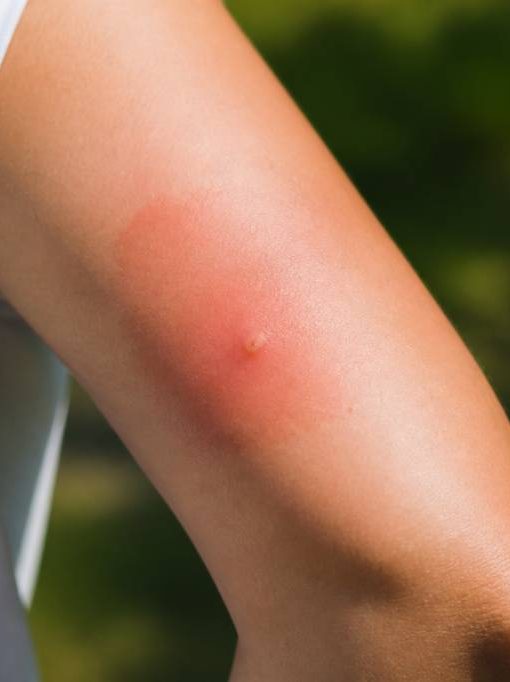 À quoi ressemble une piqûre d'abeille et quand consulter ?