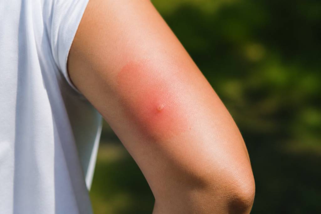 À quoi ressemble une piqûre d'abeille et quand consulter ?