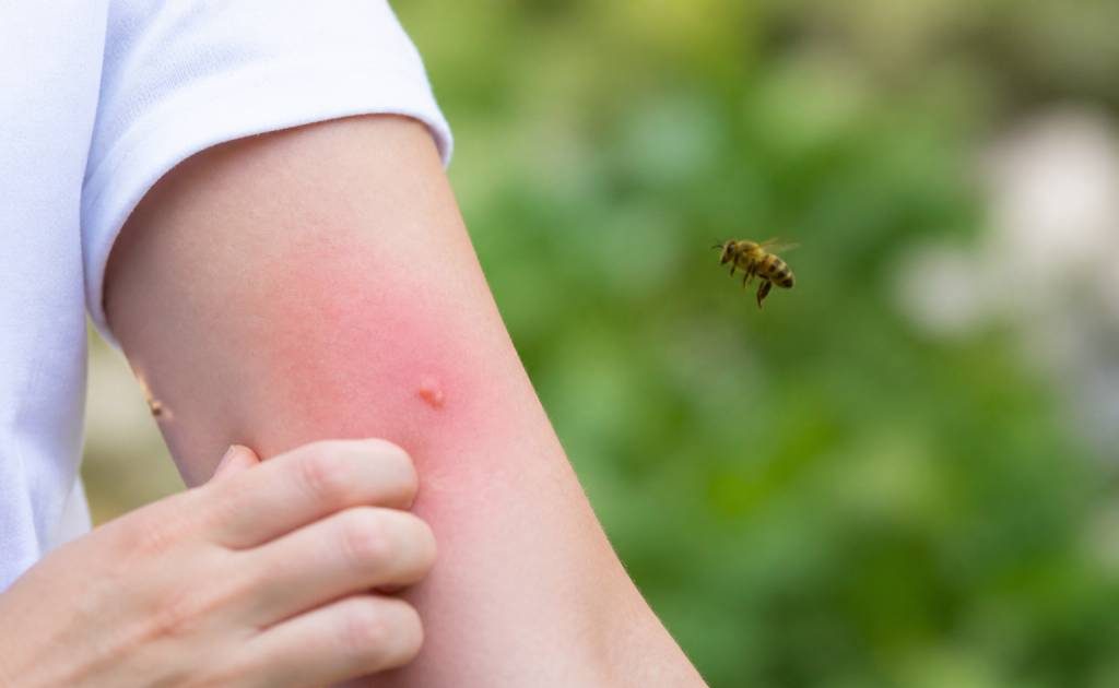 Allergie piqure d'abeille : symptômes et réactions à connaître