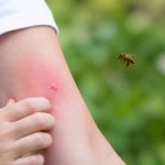 Allergie piqure d'abeille : symptômes et réactions à connaître