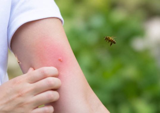 Allergie piqure d'abeille : symptômes et réactions à connaître