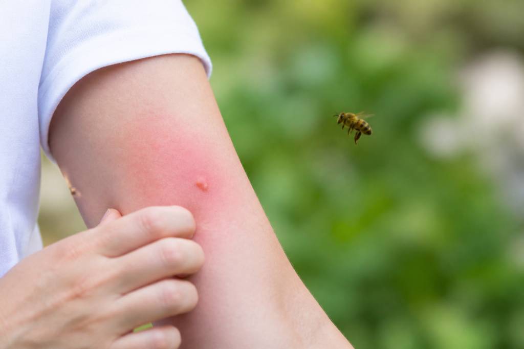 Allergie piqure d'abeille : symptômes et réactions à connaître