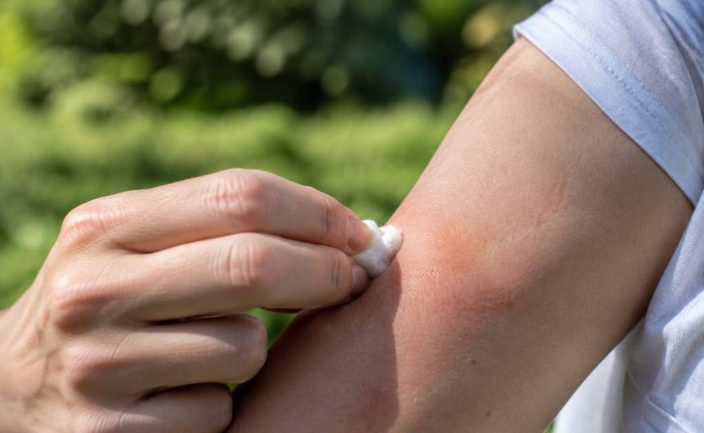 Piqûre d’abeille que faire pour soulager la douleur et réagir correctement