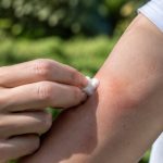 Piqûre d’abeille que faire pour soulager la douleur et réagir correctement