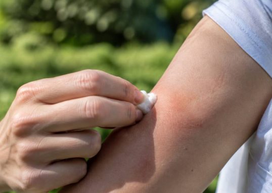 Piqûre d’abeille que faire pour soulager la douleur et réagir correctement