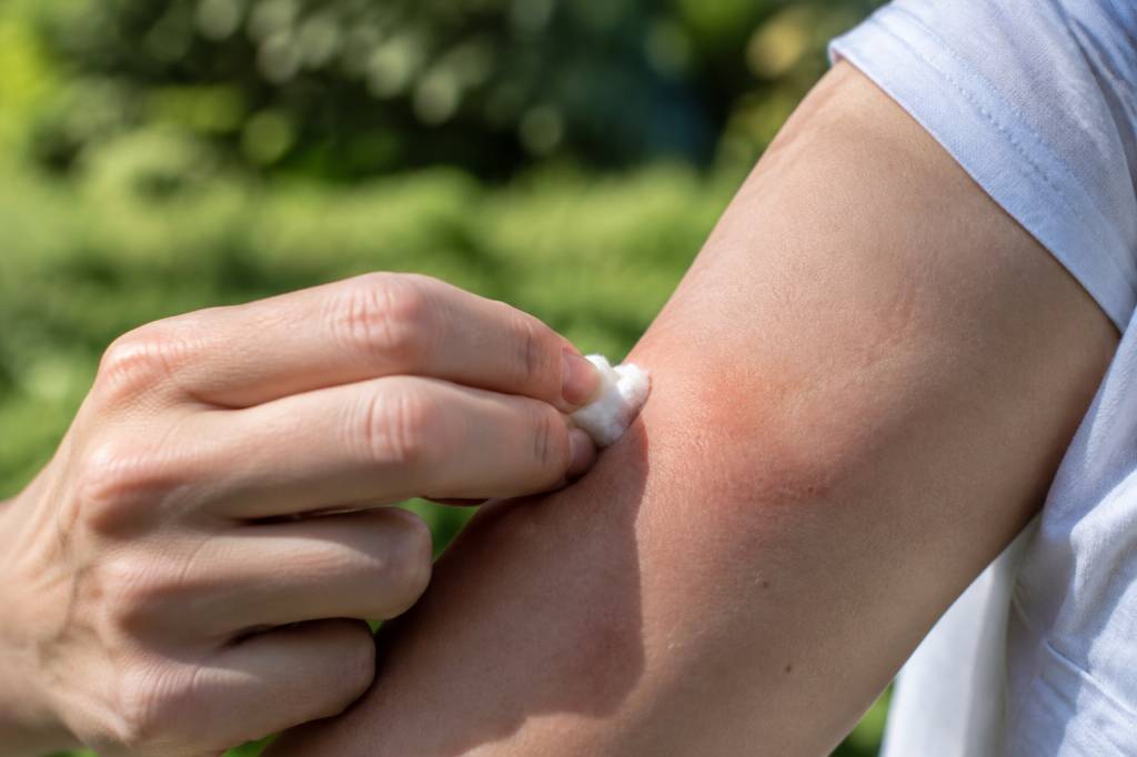Piqûre d’abeille que faire pour soulager la douleur et réagir correctement