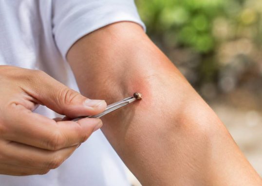 Soigner une piqure d’abeille : gestes et précautions à connaître